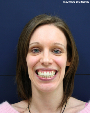 Marie-Hélène Cyr - Smile - After orthodontic treatments and orthognathic surgeries (January 29, 2010)